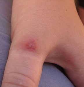 Pics Of Different Spider Bites